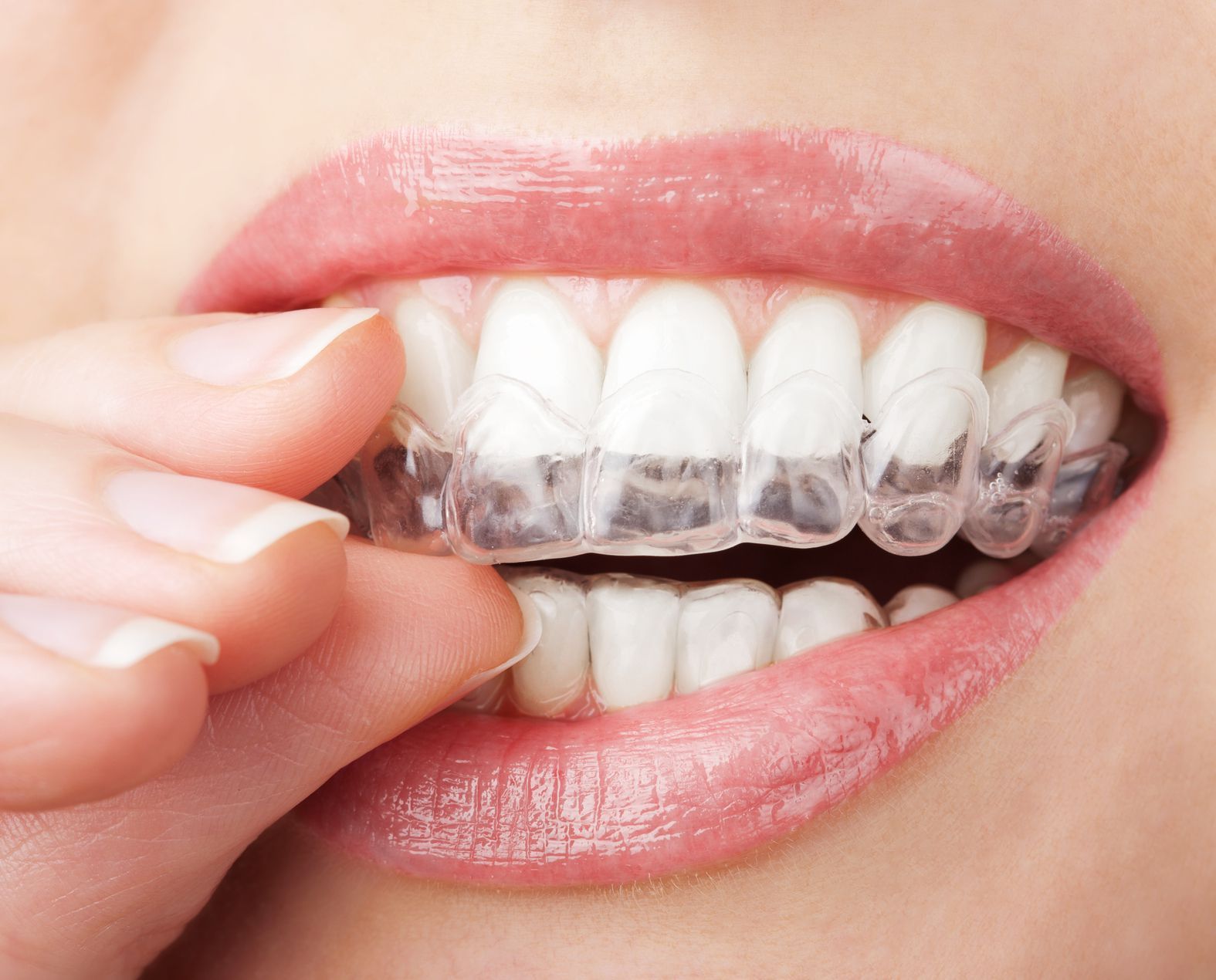 отбеливание прозрачные зубы
